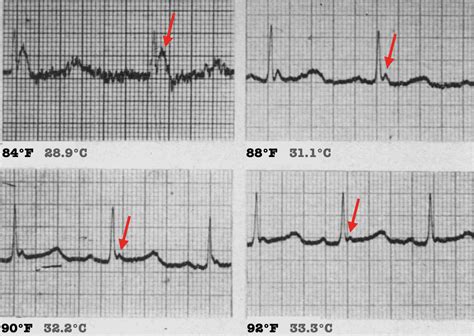 Osborn Wave (J Wave) • LITFL • ECG Library Basics