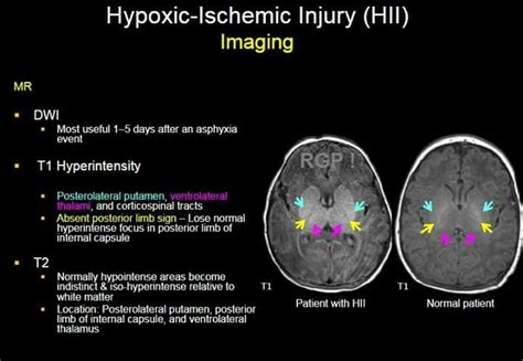 Hypoxic ischemic injury brain Radiology Student, Radiology Imaging, Brain Anatomy, Human Anatomy ...