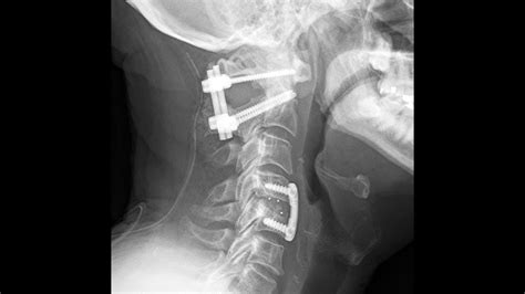 Posterior Occipital C1 And C2 Fusion Part 1 Occipital Neck Surgery | Images and Photos finder