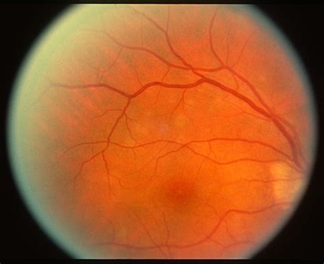 color fundus photo showing multifocal choroiditis - Retina Image Bank