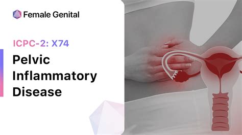 Pelvic Inflammatory Disease (ICPC-2: X74)