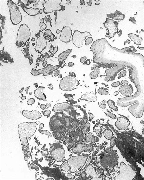 Typical hydropic degeneration (case 20, H&E, lowpower field). Amnion,... | Download Scientific ...