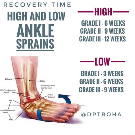 Dr. Vic Troha - ⭐️ ANKLE SPRAIN RECOVERY TIME: • 🦵There...