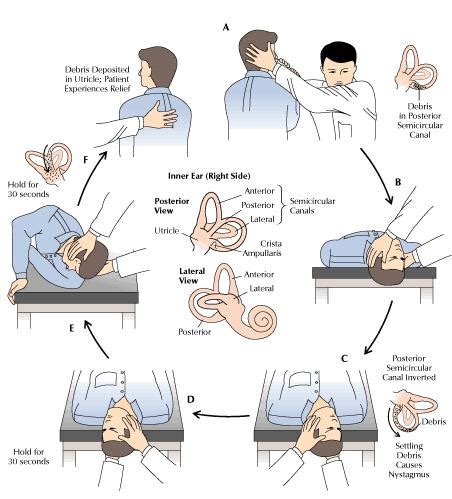 Modified Epley Maneuver Handout Spanish : Epley maneuver instructions ...