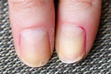 Splitting and Peeling Nails Stock Image - Image of condition, woman ...