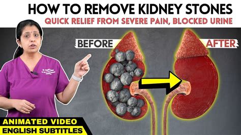 Animation - Kidney Stone Pain Relief | சிறுநீரக கற்கள் - பயங்கர வலியிலிருந்து விடுபட வழிகள் ...