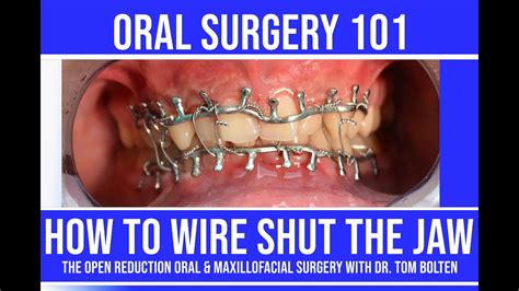 HOW TO WIRE SHUT THE JAW! | STEP by STEP LIVE INSTRUCTION | CLOSED ...