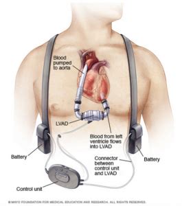 emDOCs.net – Emergency Medicine EducationLVAD Patients: What You Need to Know - emDOCs.net ...