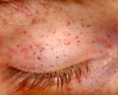 What is Petechiae : Definition, Pictures, Causes, How to get rid if ...