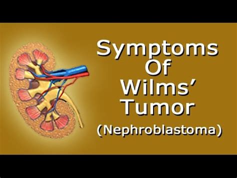 Symptoms Of Wilms' Tumor Or Nephroblastoma - YouTube