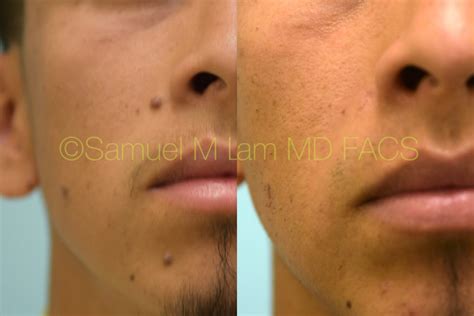 Dallas Mole Removal and Facial Excisions Before and After Photos ...