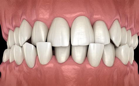 What are Crowded Teeth? Causes & Treatment Options