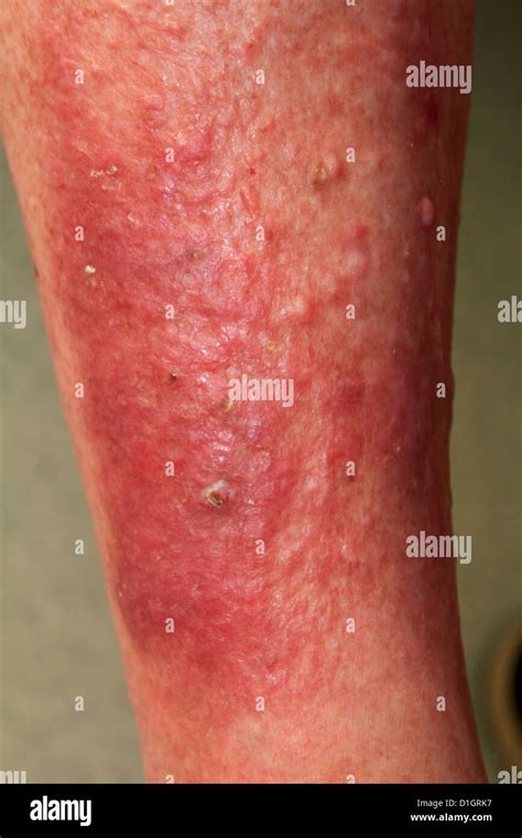 Severe Eczema or atopic dermatitis on an elderly man's leg Stock Photo ...