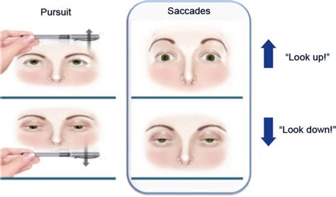 Superior Gaze Palsy