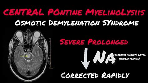 Central Pontine Myelinolysis || Osmotic Demylenation Syndrome ...