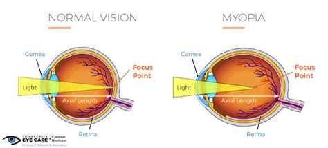 MiSight for Myopia Control | Stoney Creek Eye Care & Eyewear