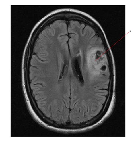 Astrocytoma Radiology