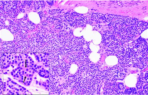 Histological appearance of the normal parathyroid gland. The gland is ...