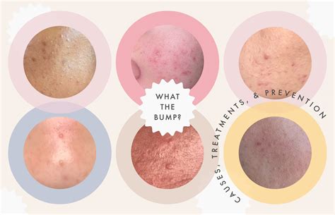 A Complete Guide to Clearing the Different Types of Clogged Pores