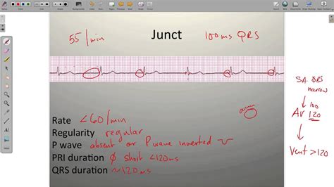 Idioventricular Rhythm Vs Junctional