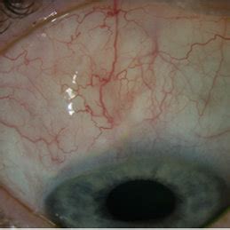 Filtering bleb of a mitomycin C (MMC) trabeculectomy 12 months after... | Download Scientific ...