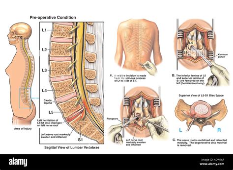 L5-S1 Disc Herniation with Hemilaminectomy and Discectomy Procedure Stock Photo, Royalty Free ...