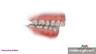 Orthodontics Treatment for Overjet (Overbite) - Herbst Appliance on ...