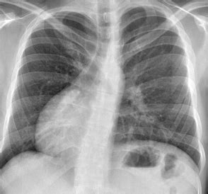 Dextrocardia