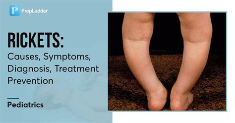 Rickets: Causes, Symptoms, Diagnosis, Treatment, Prevention