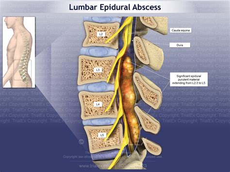 Lumbar Epidural Abscess - TrialExhibits Inc.