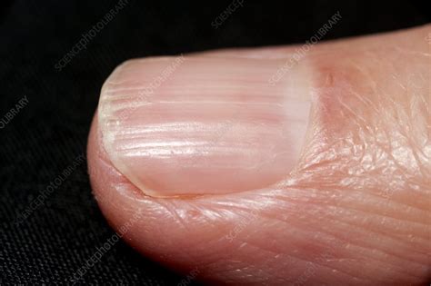 Ridged fingernail in psoriasis - Stock Image - C014/2770 - Science ...