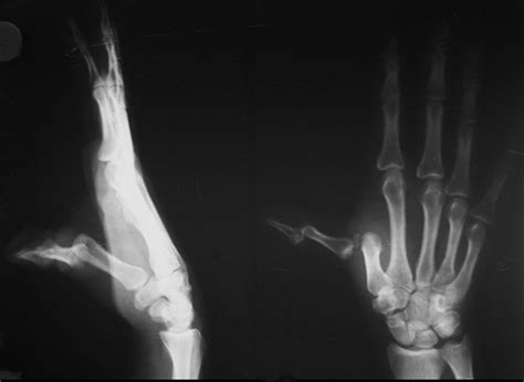 Showing Dislocation of MCP and IP Joints in Thumb | Download Scientific Diagram