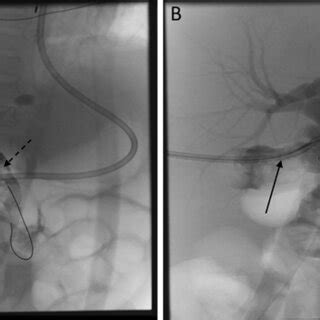 Cholecystostomy tube placement. Under ultrasound guidance, a 22-G ...