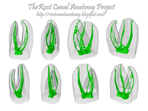 The Root Canal Anatomy Project: Middle Mesial Canal: Maxillary First Molar