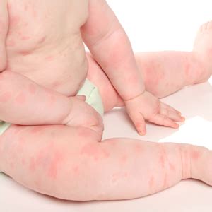 Common Baby Rashes: Different Types of Rashes in Infants