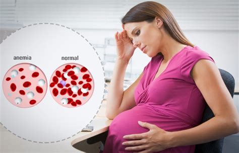 4 Easy Tips of Anemia Treatment in Pregnancy - DeveHealth