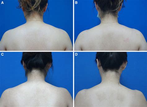 Photographs showing the change of shoulder shaping after BoNT injection... | Download Scientific ...