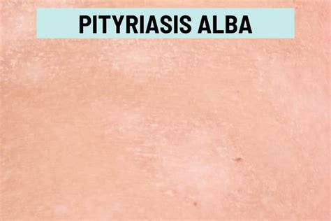 Pityriasis Alba Vs. Tinea Versicolor: Pictures and Differences