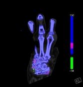 Tag: gouty arthropathy | Radiopaedia.org