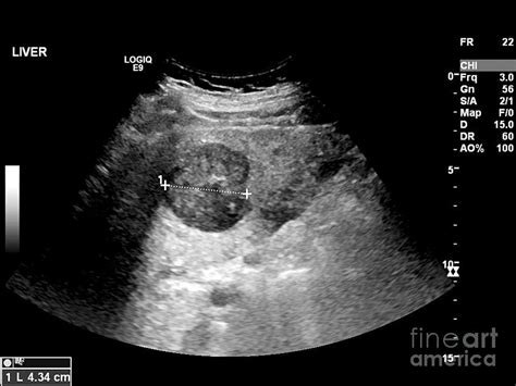 Secondary Liver Cancer, Ultrasound Scan #1 Photograph by Science Photo ...