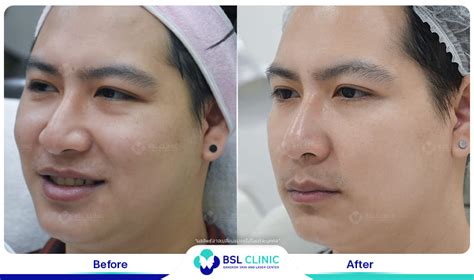 Facial Design and Anti-Aging Treatments - Bangkok Aesthetic Clinic