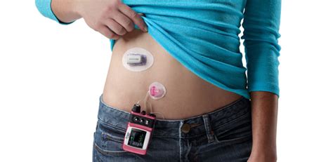 Dexcom G4 Platinum CGM cost for use with Vibe insulin pump | iPAG Scotland