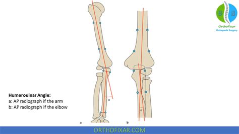 Carrying Angle Of Elbow | OrthoFixar 2024