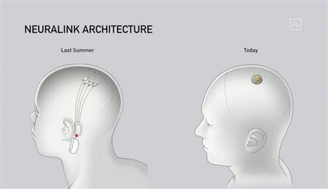 Elon Musk unveils brain chip implant: 'It's like a Fitbit in your skull ...