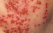 Eczema Herpeticum - What is it and is it dangerous? - Eczema Blues