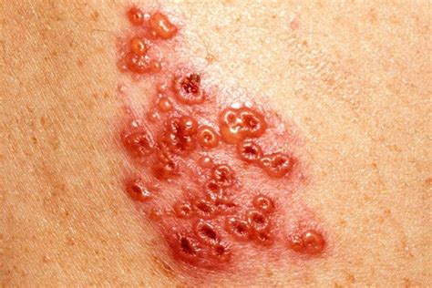 Shingles Vaccine Info. – Health Choice Vermont