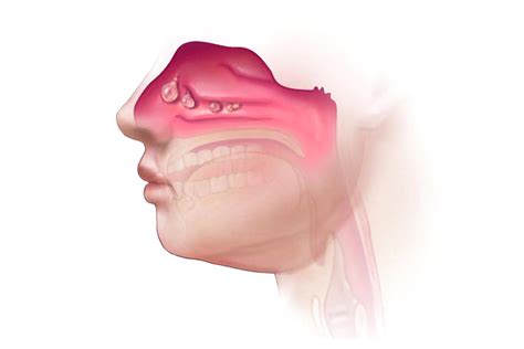 Nasal Polyposis | Northern Valley Allergy