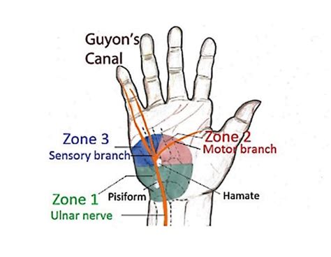 Ulnar Nerve Compression & Wrist Treatment In Kuala Lumpur