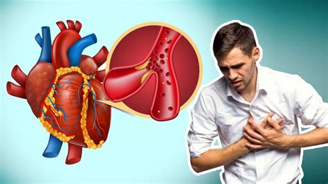 Myocardial Infarction: All You Need To Know About This Heart Disease