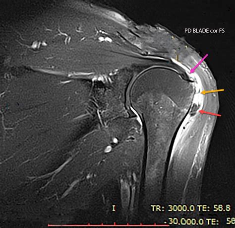 Calcific tendinosis - Radiology For Beginners by Dr. Samuel Kobba